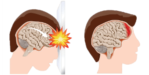 TBI Head Injury